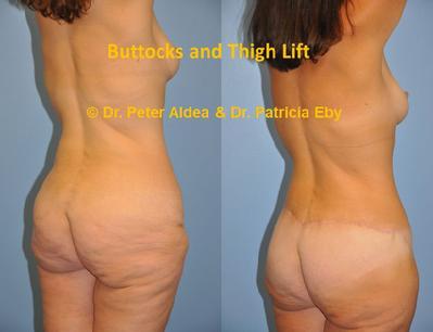 Butt Thigh Lift  Dr. Aldea