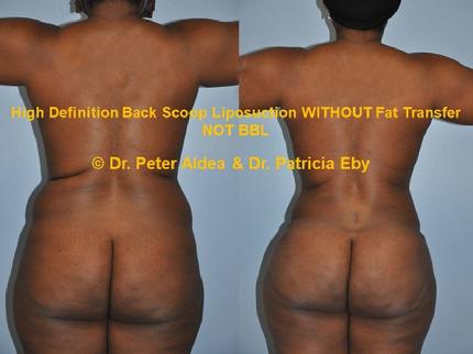 Hi Def Back Scoop Liposuction  Dr. Peter Aldea