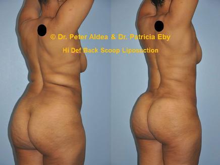 Hi Def Back Scoop Liposuction  Dr. Aldea