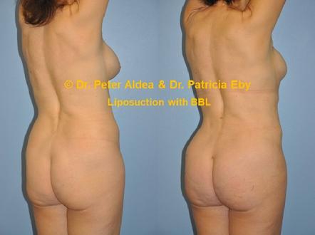 Precision BBL Dr. Peter Aldea