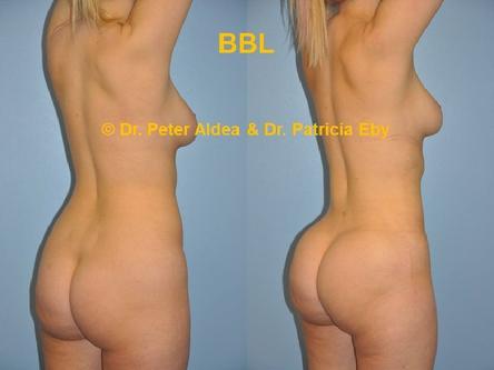 Precision BBL Dr. Peter Aldea