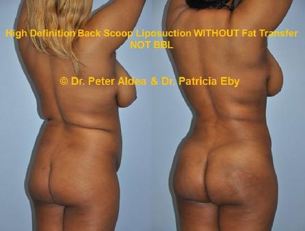 Hi Def Back Scoop Liposuction  Dr. Peter Aldea