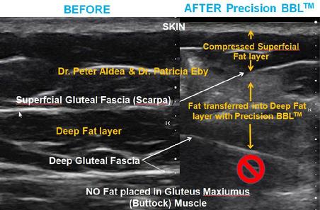 Precision BBL Dr. Aldea