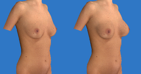 Scarless 3D Virtual Breast Augmentation