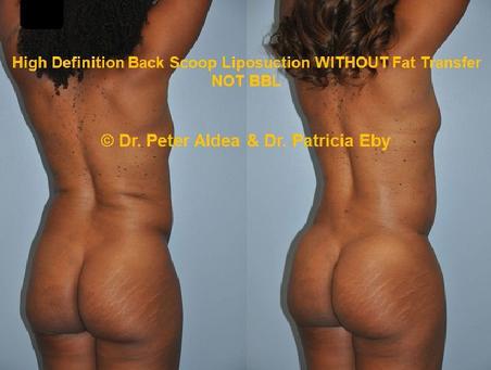 Hi Def Back Scoop Liposuction  Dr. Peter Aldea