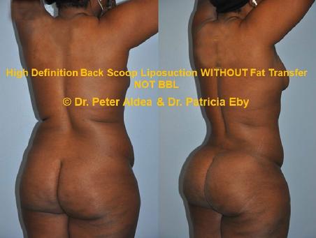 Hi Def Back Scoop Liposuction  Dr. Peter Aldea