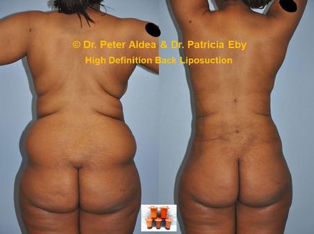 Hi Def Back Scoop Liposuction  Dr. Peter Aldea