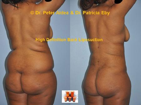 Hi Def Back Scoop Liposuction  Dr. Peter Aldea