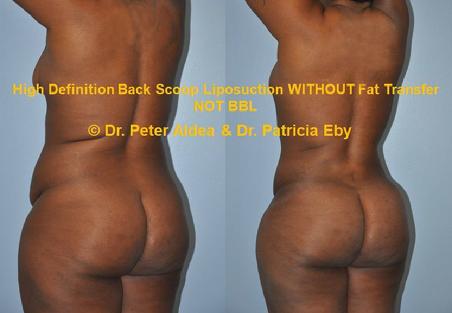 Hi Def Back Scoop Liposuction  Dr. Peter Aldea