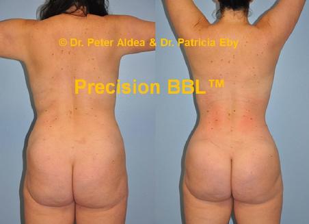 Precision BBL Dr. Peter Aldea