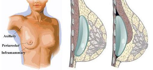 MONOBOOB - the causes and treatment of this potential complication of  breast implants 