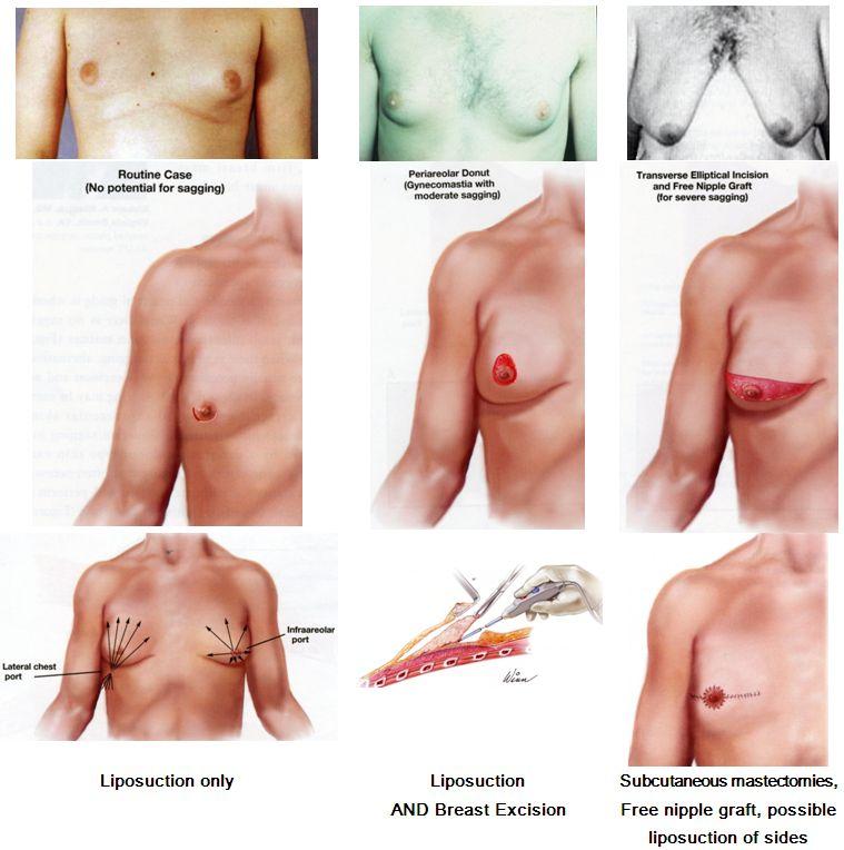 MAN BREASTS GYNECOMASTIA EXPERT Dr. Peter A. Aldea Cosmetic