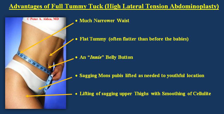 Tummy Tuck, Memphis, Plastic Surgery